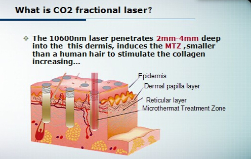 Laser fracionário profissional do CO2 de Er700b para a remoção das marcas de estiramento