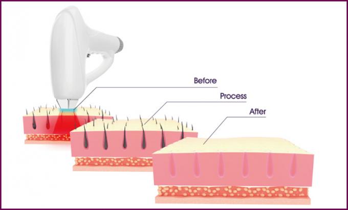 máquina permanente da remoção do cabelo da clínica indolor do laser do diodo 808nm