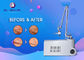 10.6 Microns Micro CO2 Fractional Laser Machine For Eye Protection